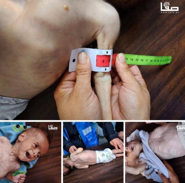 سنتيمترات-معدودة.-أذرع-أطفال-غزة-تختصر-حجم-مأساة-الجوع