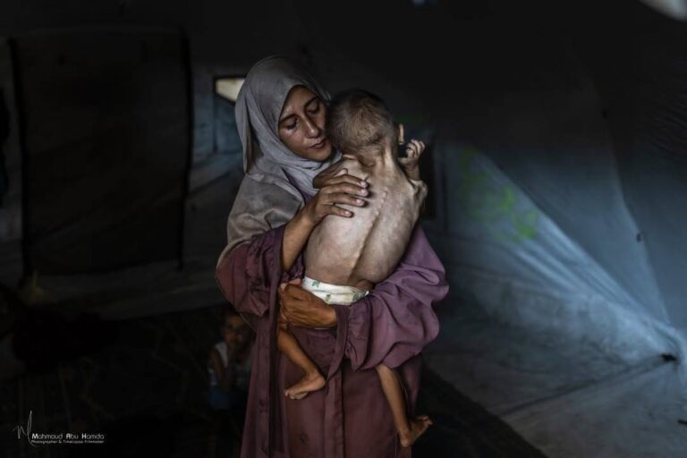 الطفل-محمد-المطوق-يصارع-الموت-جوعاً-في-غزة-بوزن-6-كيلوغرامات